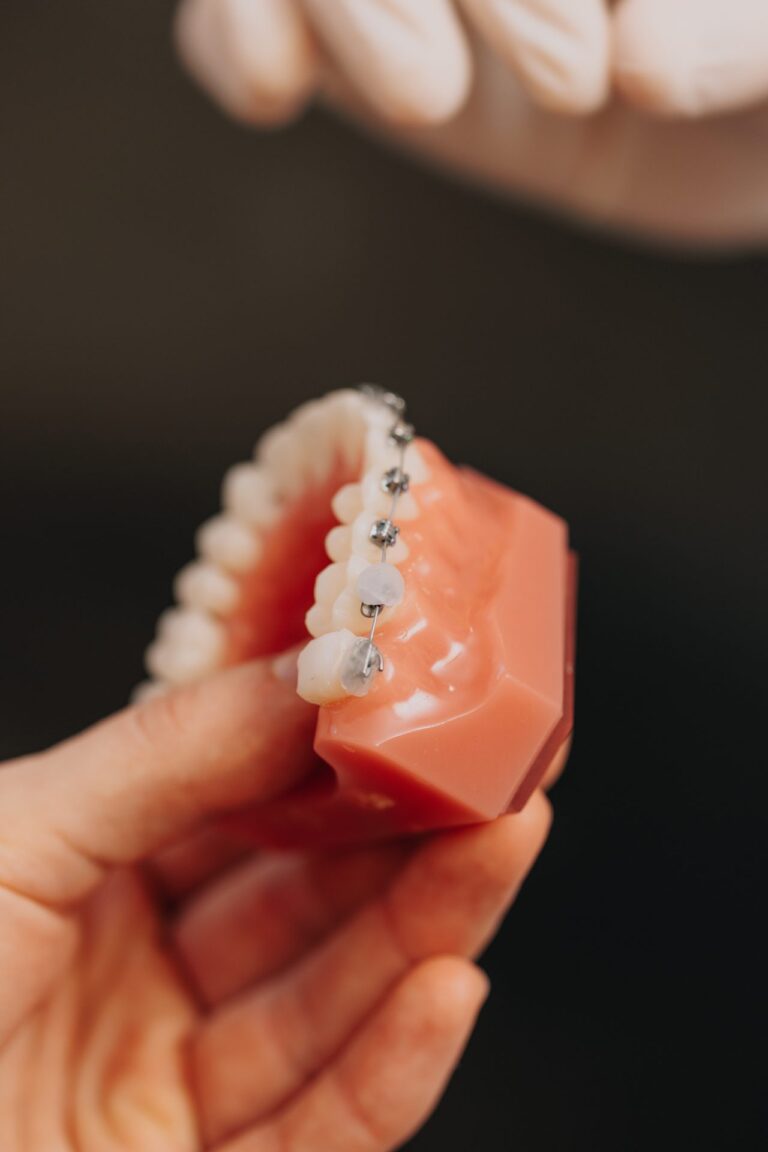 Zahnfarbene Keramik-Brackets am Zahnmodell in Nahaufnahme